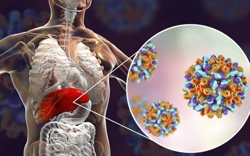 Detectan prevalencia alta de Hepatitis 